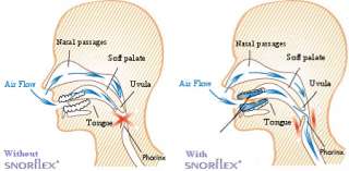 SNORFLEX   STOP SNORING   for a refreshing sleep  